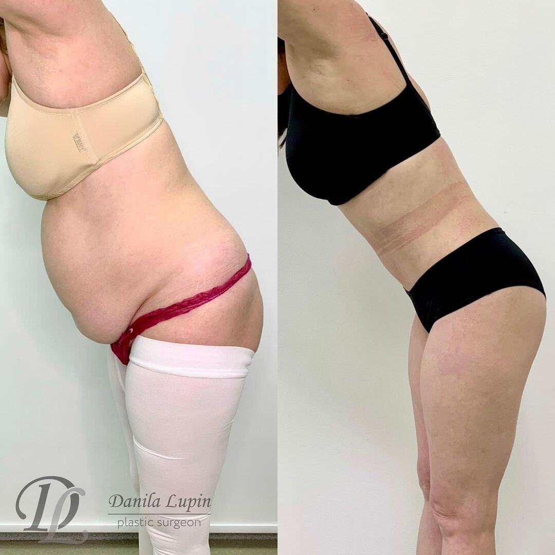 Абдоминопластика до и после. Фото предоставлено пациенткой Данилы Лупина. Имеются противопоказания, необходима консультация специалиста 