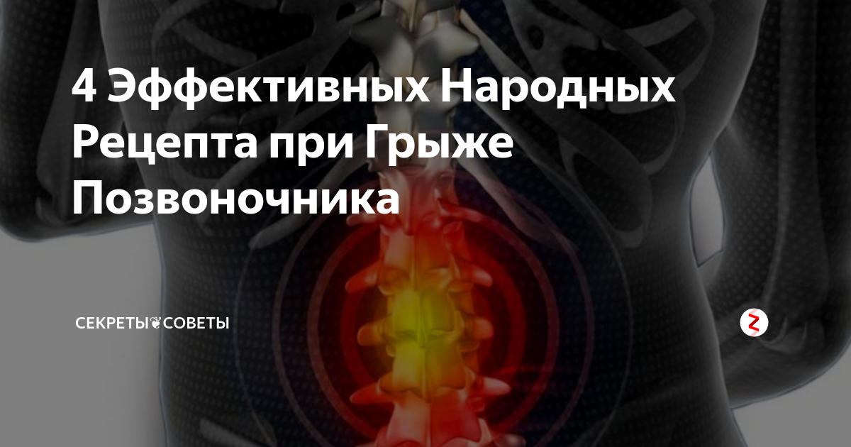 Лечение грыжи поясничного отдела народными средствами. Народное средство от грыжи. Заговор от грыжи на позвоночнике. Народные средства для позвоночника. Боль от грыжи позвоночника.