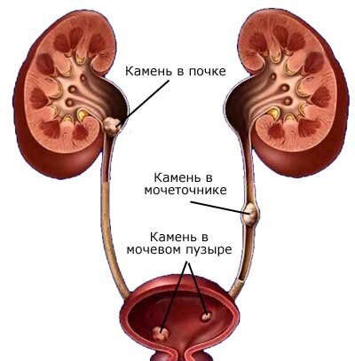 Камни в почках