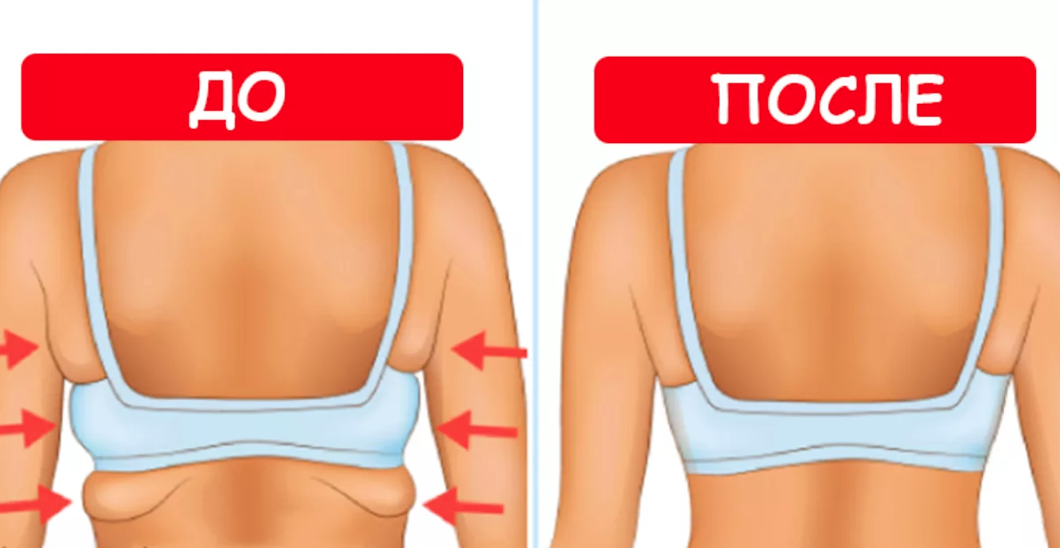 Как убрать складки на спине быстро. Как понять причину и убрать жировые складки кожи навсегда