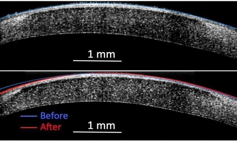 Новый неинвазивный процесс может изменить кривую роговицы глаза от  того состояния, которое обозначено синим цветом, к новой позиции,  отмеченной красным цветом, чтобы исправить проблемы со зрением.  