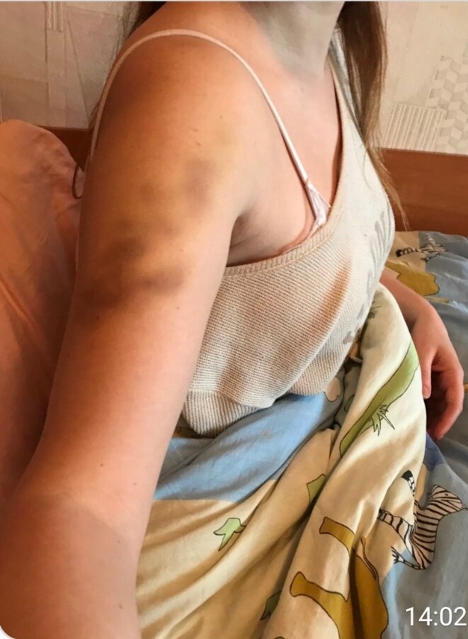 Синяки после массажа 