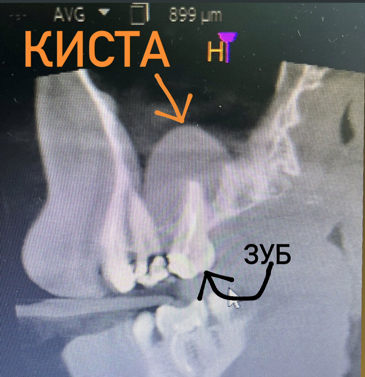 Связь кисты пазухи носа и зуба