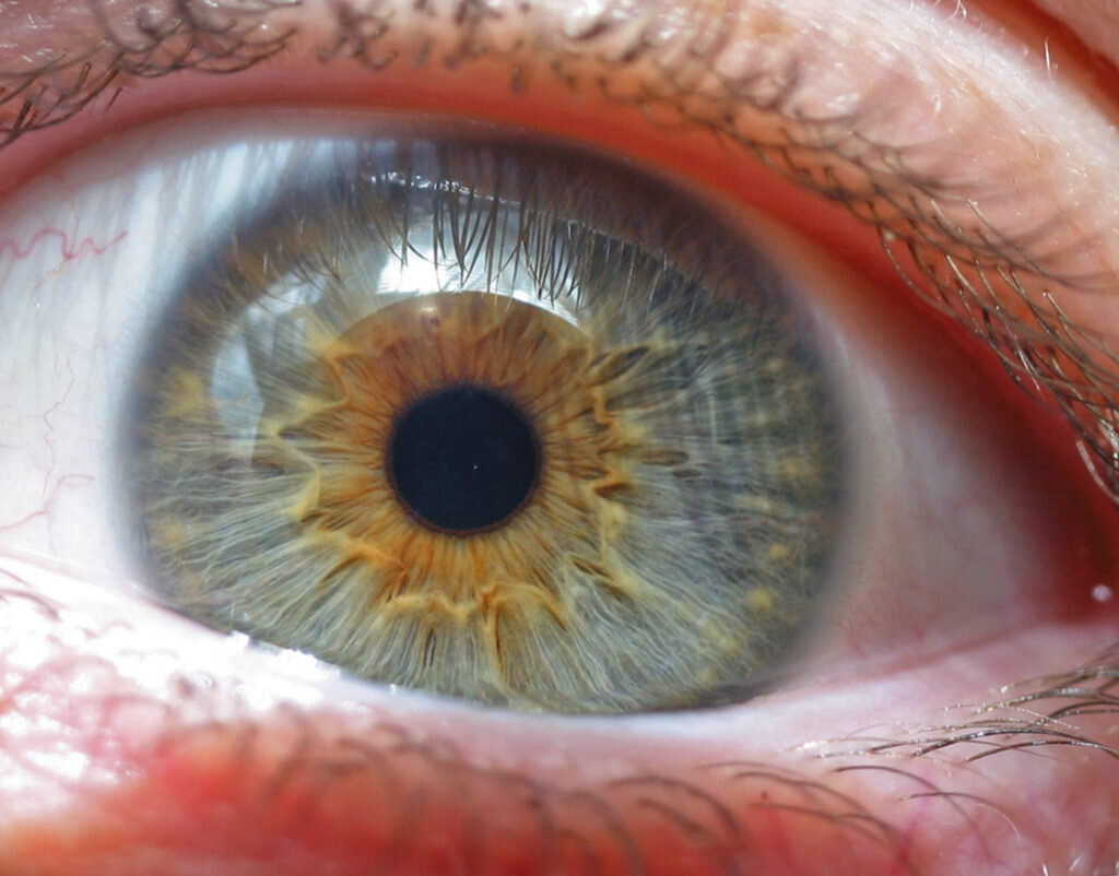 Наличие карего пигмента на серой радужке