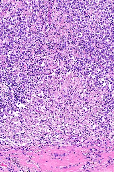 https://commons.wikimedia.org/wiki/File:Seminoma_with_granulomas_-_alt_---_intermed_mag.jpg