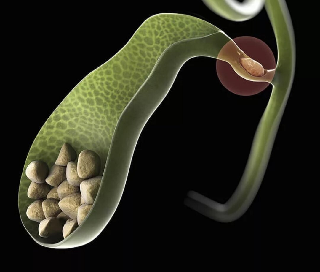 Застой желчи лечение. Желчекаменная болезнь. Желчнокаменная болезнь. Желчекаменная болезнь холелитиаз. ЖКБ камни желчного пузыря.