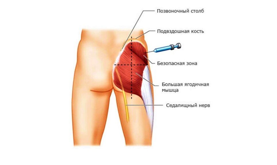 Какие уколы делают при защемлении нерва в пояснице