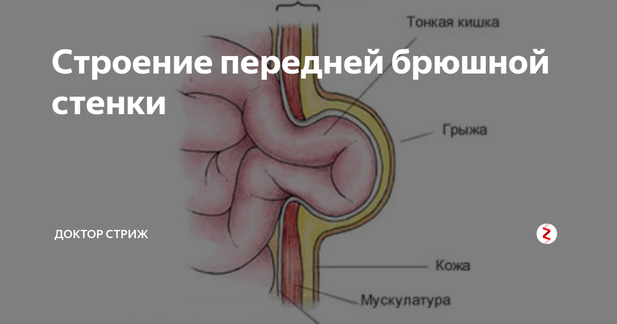 Грыжа симптомы Грыжа симптомы