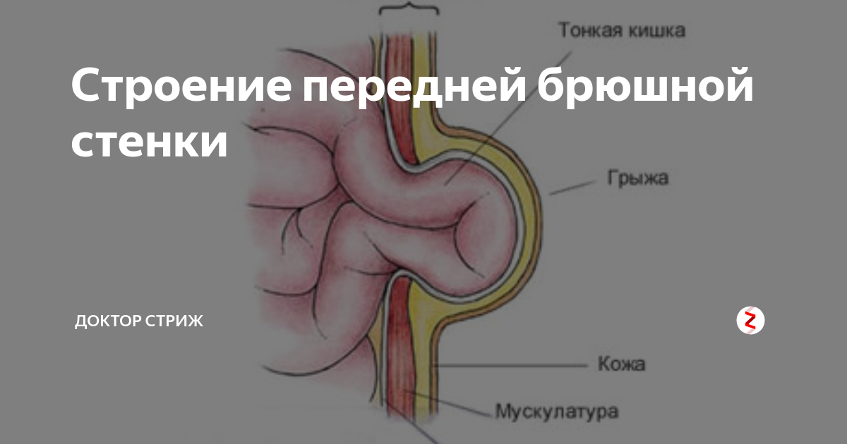 Грыжа передней стенки