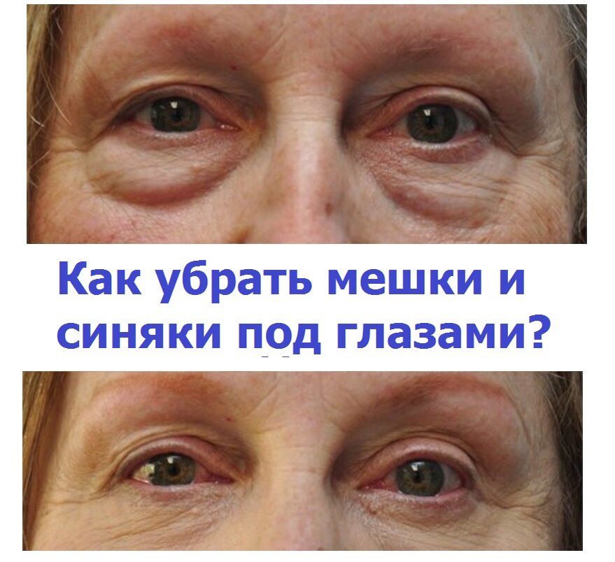 Отекшие глаза причины и лечение у женщин. Мешки под глазами. Возрастные отеки под глазами. Убирание отеков под глазами. Возрастные мешки под глазами.