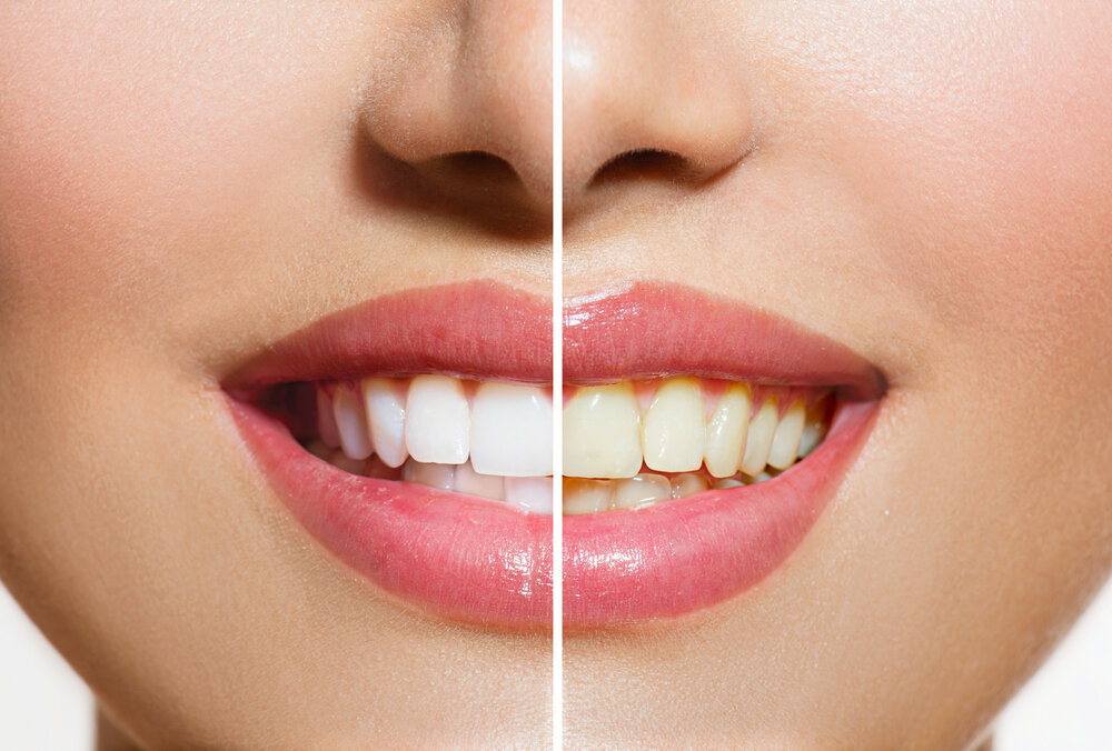   Отбеливание зубов — это рядовая стоматологическая процедура, и тем не менее она обросла огромным количеством мифов и легенд. В этой статье мы ответим на самые популярные вопросы об отбеливании зубов.