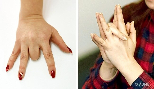   1.Парализованный палец   Сложите ладони вместе и скрестите средние пальцы между собой. По очереди разъедините большой палец, указательный и мизинец. Получилось?