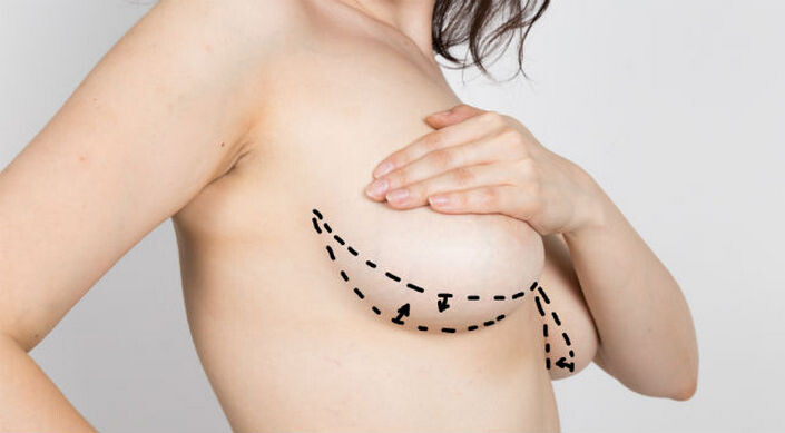 Мастопексия – одна из самых востребованных процедур в мировой пластической хирургии. Ее успешно практикуют много десятилетий, а по уровню популярности она не уступает операциям по увеличению груди. Современные разновидности мастопексии позволяют решать широкий круг эстетических проблем: устранять сильный гравитационный птоз, восстанавливать привлекательный профиль груди при возрастных изменениях и после родов, моделировать их размер, улучшать контур и многое другое. Как это часто бывает с популярными операциями, мастопексия окружена различными домыслами и множеством некомпетентных мнений.