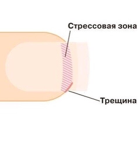 Почему ногти могут расслаиваться и ломаться, и как с этим справиться?