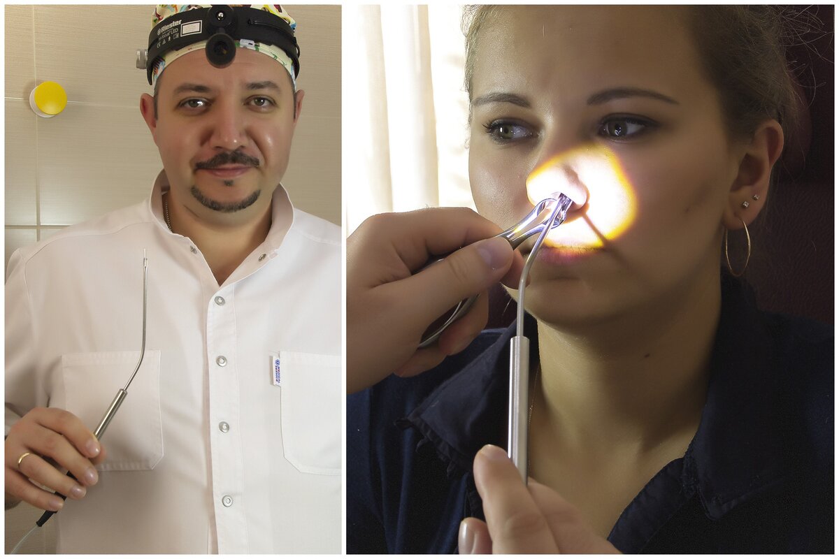 Радиоволновая коагуляция нижних носовых раковин в "ЛОР КЛИНИКЕ ДОКТОРА ЗАЙЦЕВА"