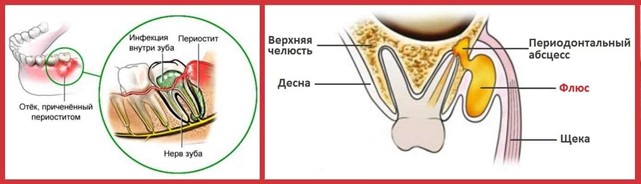 Как вылечить флюс на десне без дальнейших осложнений?