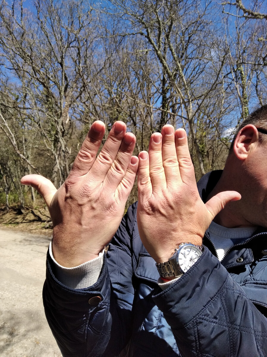 Тыл рук Евгения. Фото из личного архива.