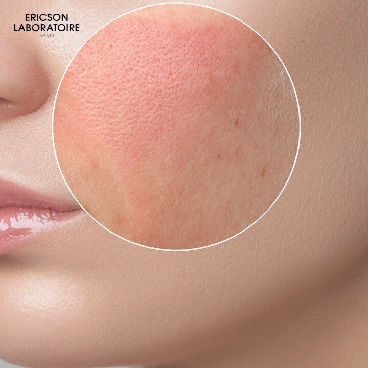 Аллергия на солнце, или фотосенсибилизация 