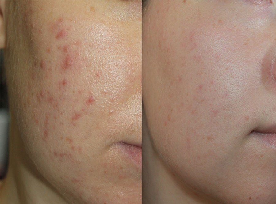 Избавьтесь от прыщей за один день или самое эффективное средство для проблемной кожи.