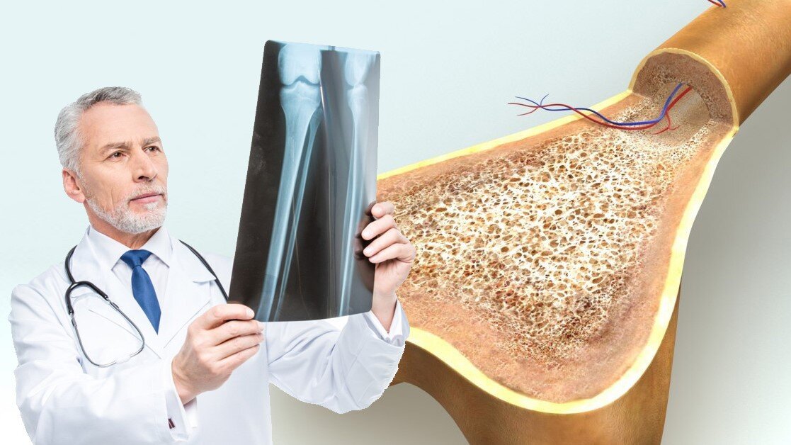 ломкость костей. остеопороз костяного отломка. остеопороз патанатомия. старение позвоночника. пористые кости.
