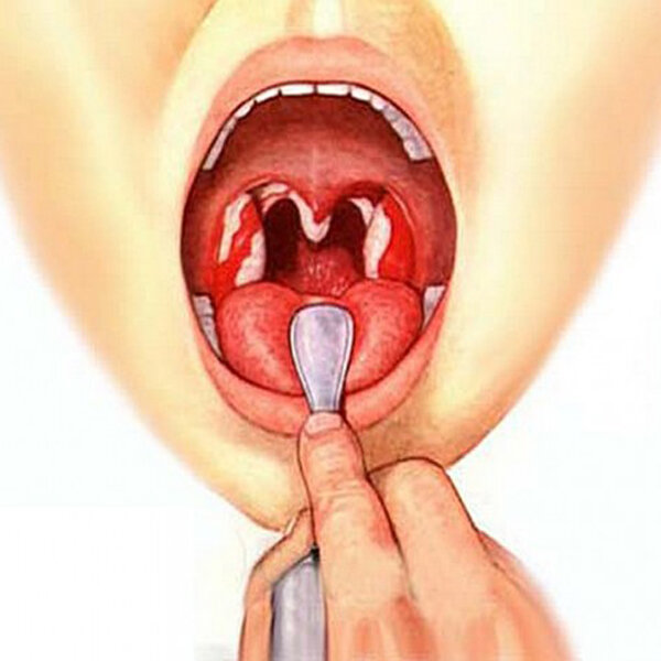 Ангина - это острое инфекционное заболевание небных миндалин