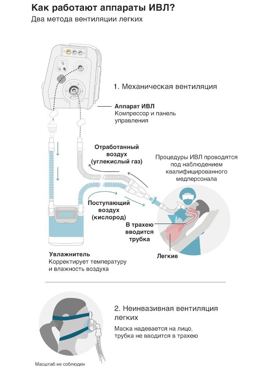 Аппарат искусственной вентиляции лёгких (ИВЛ