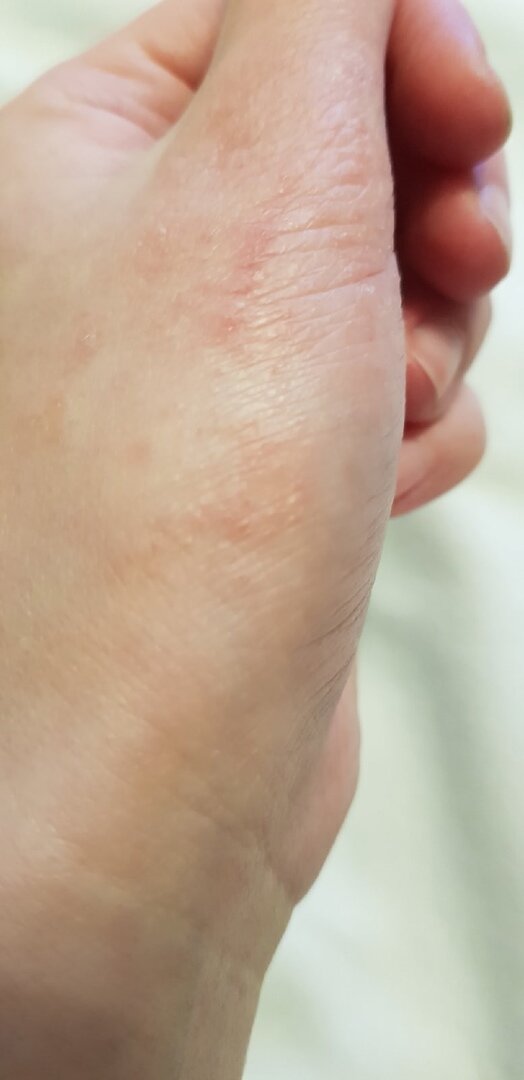 Атопический дерматит в стадии обострения