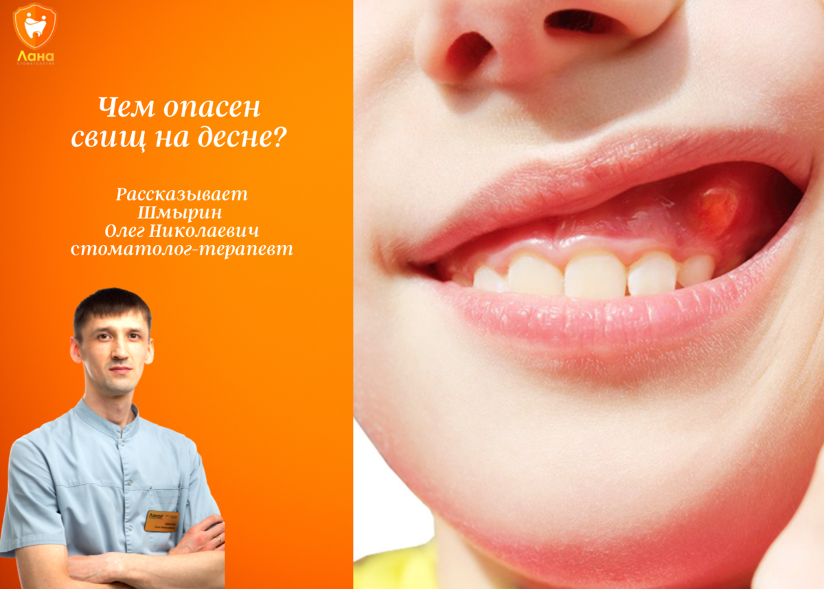 Что такое свищ на десне - Арт Минск.ру