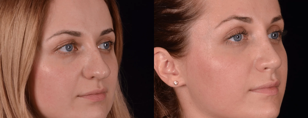 Ринопластика толстого носа с опущенным кончиком фото до и после. Фото до и после. Фото с сайта Д.Р. Гришкяна. Имеются противопоказания, требуется консультация специалиста