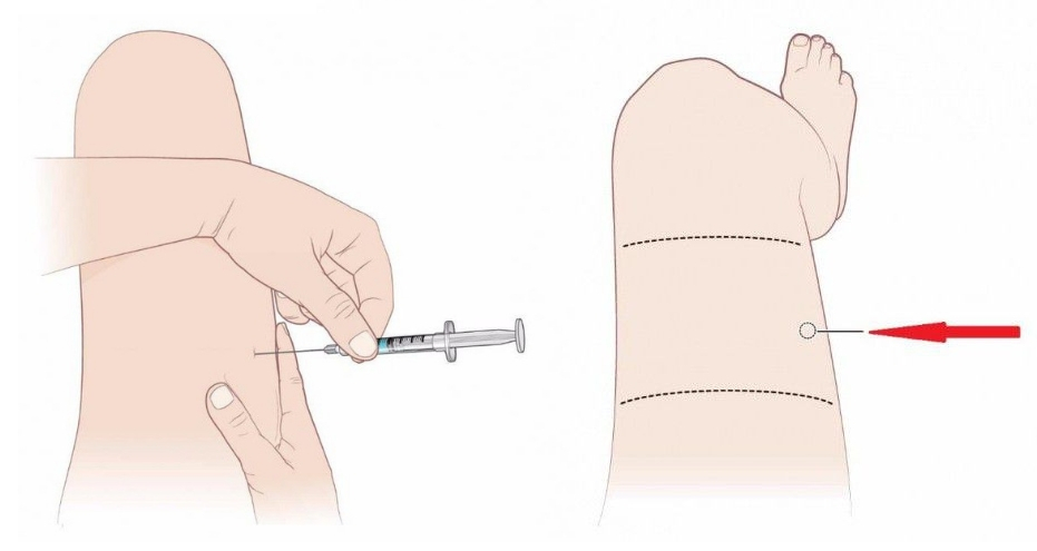 Внутримышечный укол в бедро. Как правильно поставить укол в бедро самому себе. Укол в бедро самому себе внутримышечно. Сделать укол внутримышечно самому. Как ставить укол внутримышечно в бедро самому себе.