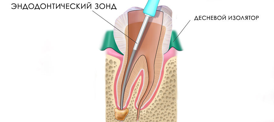 Пример лечения кисты без удаления зуба