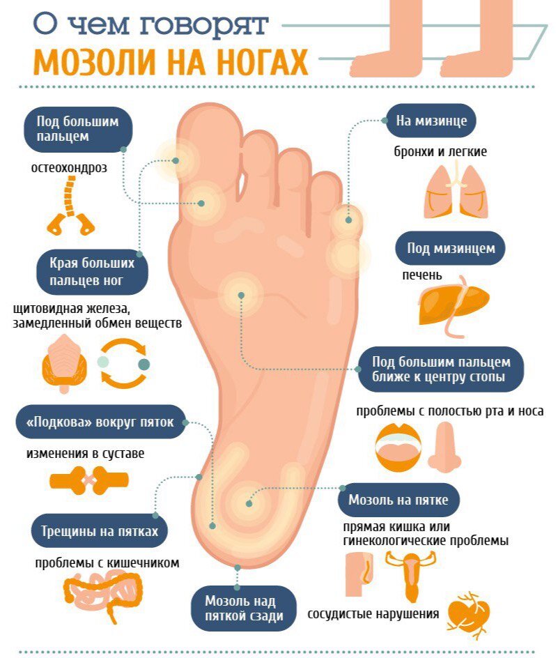 Мозоли на ногах: виды, причины появления, лечение, профилактика