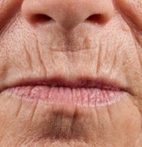  Особенности анатомии и фи­зиологии губ, определяют повышен­ную чувствительность этого региона к воздействию внешних и внут­ренних факторов.