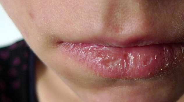 Как должны выглядеть здоровые губы?