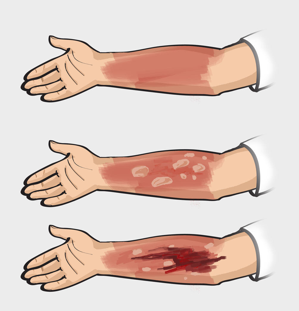 Первая помощь при ожоге: что можно и чего нельзя