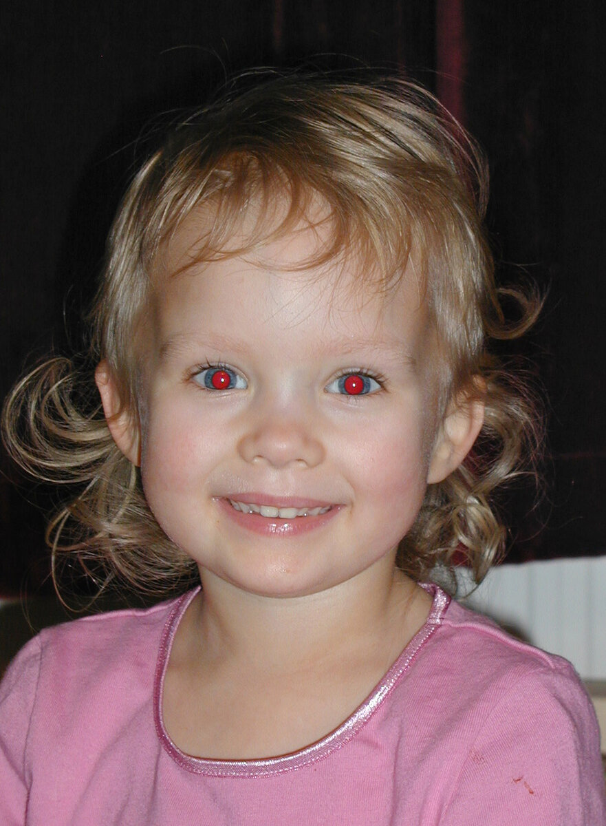 Офтальмологи объяснили, о чем на самом деле говорят «красные глаза» на фото
