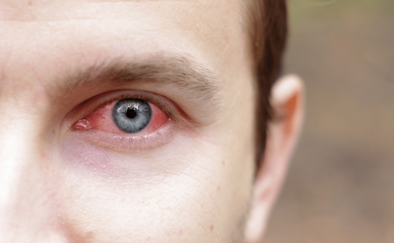 На данной фотографии продемонстрирован ожег легкой степени тяжести