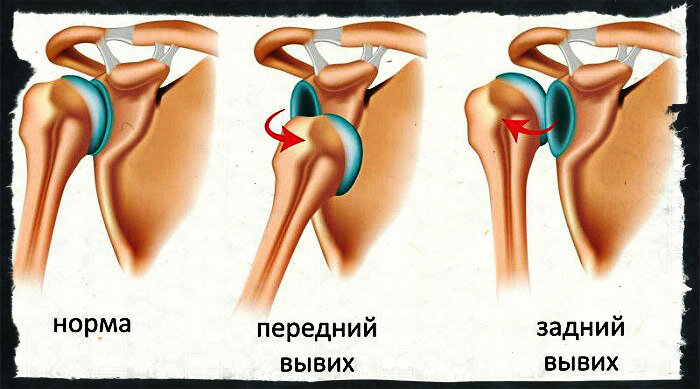 Вывих плечевого сустава: симптомы, причины, диагностика и лечение