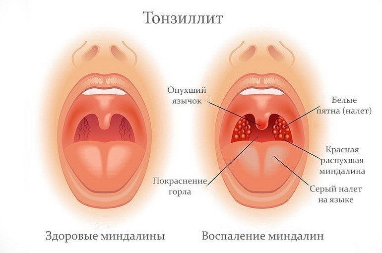 Основные симптомы ангины