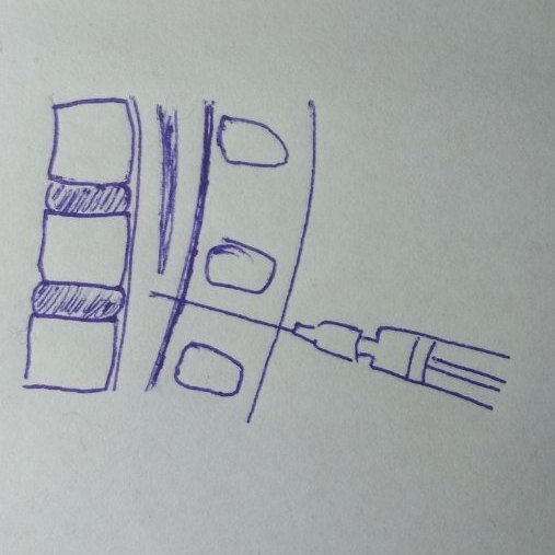 Рисунок 1. Люмбальная пункция.