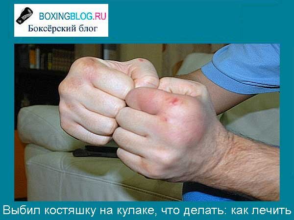 Что делать, если выбит палец на руке: практические советы | boxingblog | Дзен