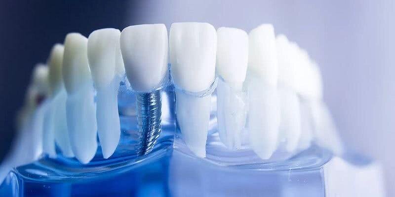 Имплантант и готовая коронка