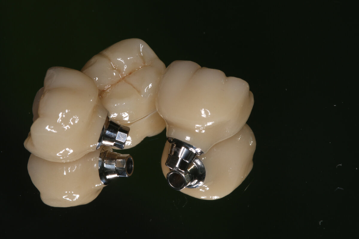 Коронки из циркония с опорой на импланты и зуб (вид коронок не в полости рта). Врач Жданов Илья Игоревич