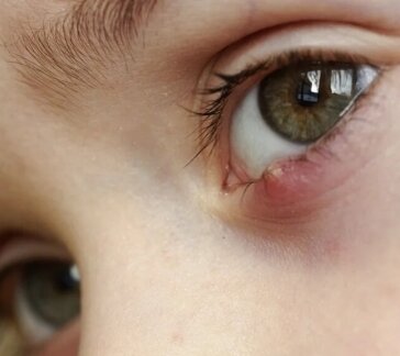 Глазные капли от ячменя - какие бывают, как применяются. Самая актуальная информация