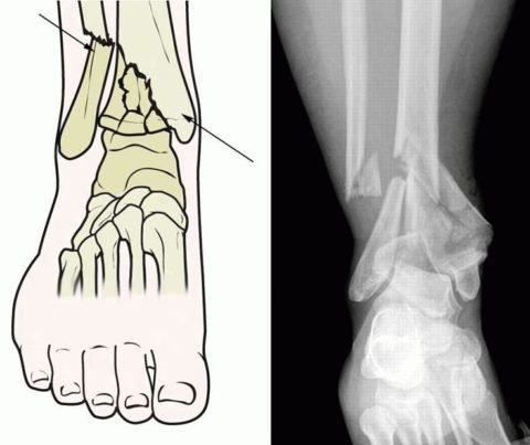  Фото: Травмы голеностопного сустава