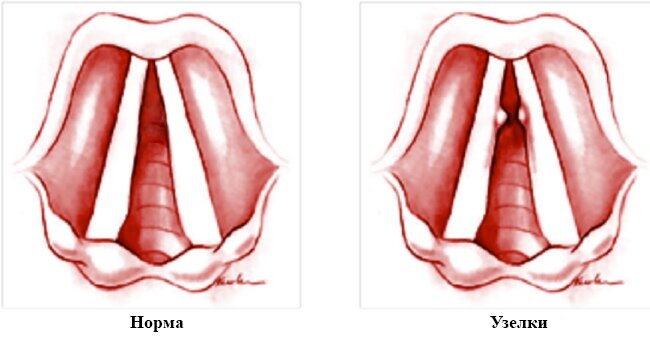 Вид голосовой связки в норме и с узелком