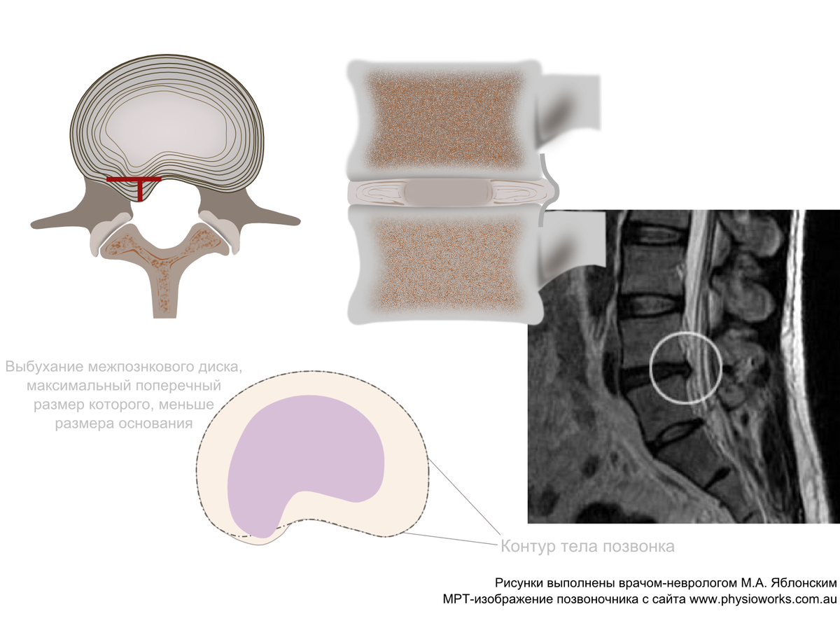 Экструзии дисков позвоночника поясничного отдела. Секвестрированная экструзия. Грыжа позвоночника экструзия диска. Экструзия дисков позвоночника поясничного. Экструзия это грыжа.