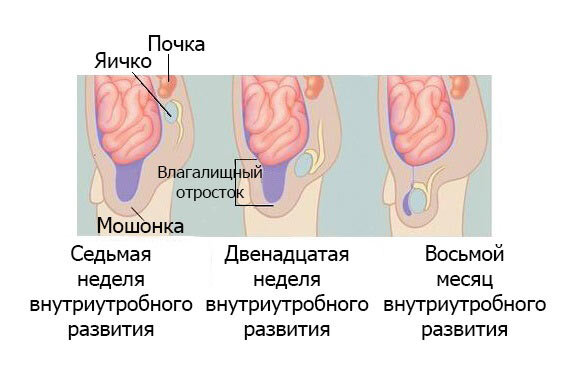 Крипторхизм у взрослых мужчин