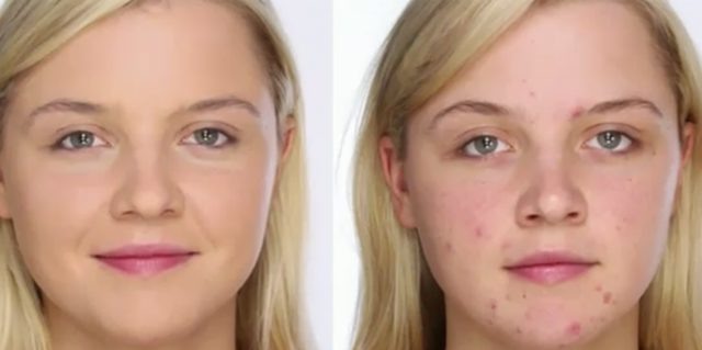  Как замаскировать прыщи на лице? Проще и быстрее всего сделать это с помощью косметики