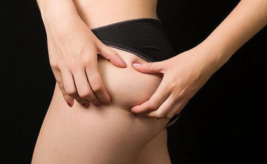 Первая стадия патогенетически обусловлена застоем интерстициальной жидкости между клетками жировой ткани, так называемый «мягкий целлюлит.